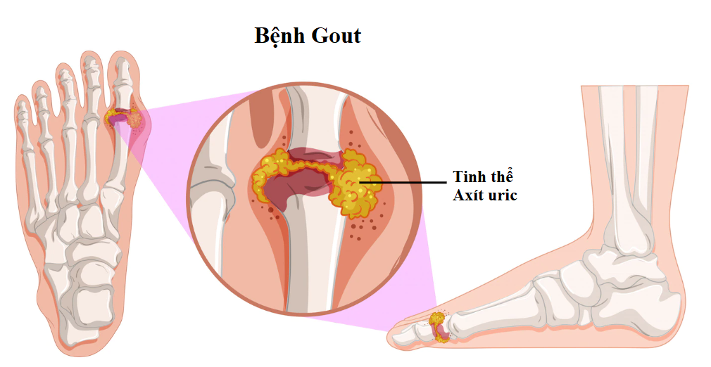 Gout là một loại bệnh gây ra do tăng mức axit uric trong cơ thể